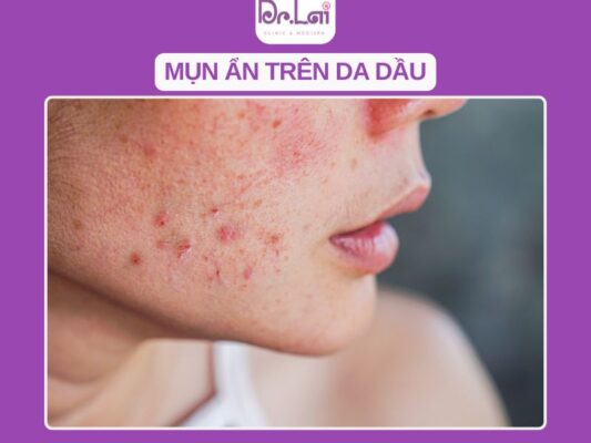 Mụn ẩn